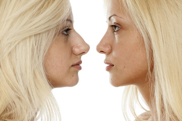 comparison of nose surgery, befora and after