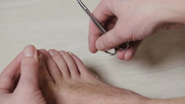Man cutting toenails with scissors. Male cut toenails on foot. Toenails with fungal infection 