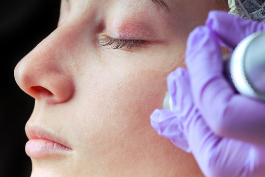 Needle mesotherapy. Beautician performs a needle mesotherapy treatment on a woman's face