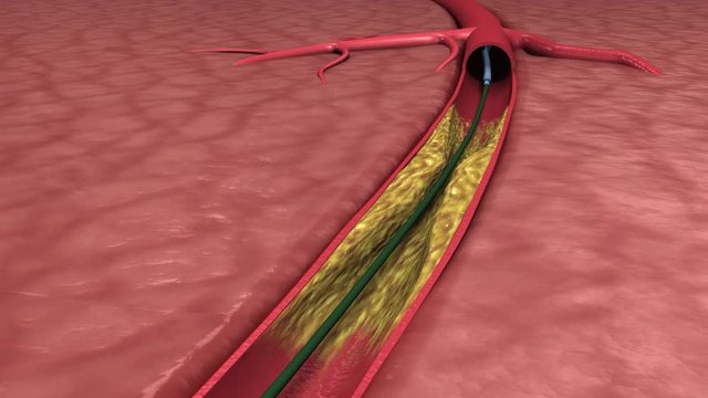angioplasty balloon animation