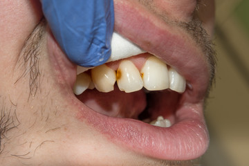 close-up of a human rotten carious tooth at the treatment stage in a dental clinic