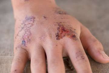 Doctor show wounds on the hand, Cause of motorbike accident. Soft focus and blur. Healthy concept.