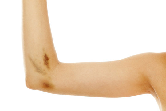 Woman Hand With A Bruise Near The Elbow