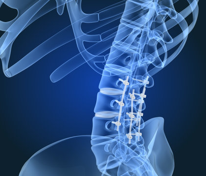 Spinal fixation system - titanium bracket. X-ray view. 3D illustration