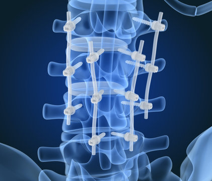 Spinal fixation system - titanium bracket. X-ray view. 3D illustration