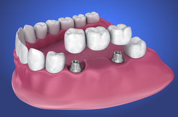 implant supported fixed bridge. Medically accurate 3D illustration