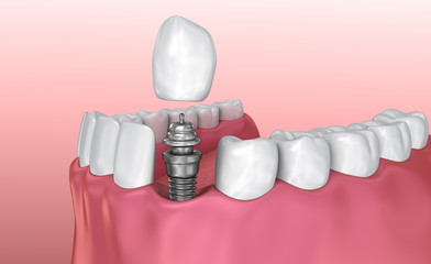 Tooth implant and crown installation process. Medically accurate 3D illustration