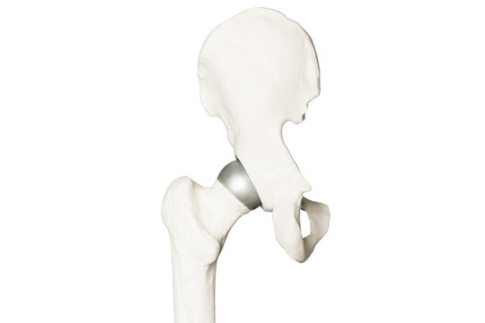 Orthopädie Skelett vom künstlichen Hüftgelenk implantant Hüftprothese Frontal