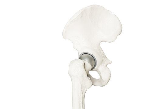 Orthopädie Skelett vom künstlichen Hüftgelenk implantant Hüftprothese Seitenansicht seitlich