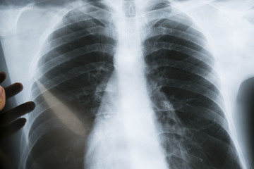 View of a child x-ray film, taken to examine the lungs