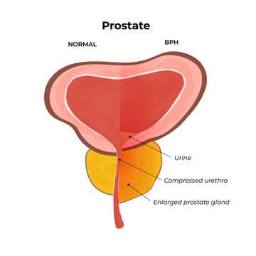 BPH infographics. Prostatic hyperplasia. Normal and inflamed prostate gland