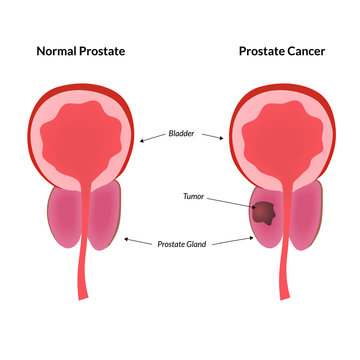 Tumor in prostate gland is a common cancer harbinger