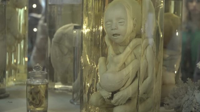 Anatomical preserved human specimens, ugliness, anomalies. Human parts of the body preserved in formalin for scientific study by scientists. Exhibition items in autopsy room.