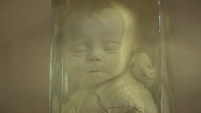 Anatomical preserved human specimens, ugliness, anomalies. Human parts of the body preserved in formalin for scientific study by scientists. Exhibition items in autopsy room.