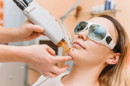 In a cosmetology clinic, a woman receives a treatment in the face area, the laser removes the mole