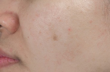 Acne spot on face skin of Asian woman. Concept before face laser treatment for get rid of dark spot post-acne.