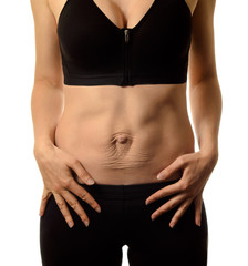 Fototapeta na wymiar Diastasis recti. Woman's abdomen divergence of the muscles of the abdomen after pregnancy and childbirth.