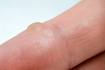 wart on the finger verruca freeze concept  blurred neutral background, selective focus