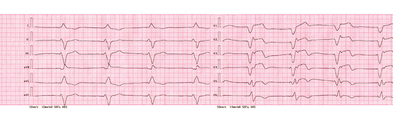 ECG with rhythm of artificial pacemaker (ventricular pacing)