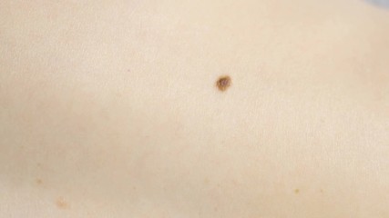 Dark brown mole on white skin. View top.