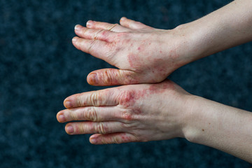 Young woman with dry and stressed red dyshidrotic eczema covered hands - 191726661