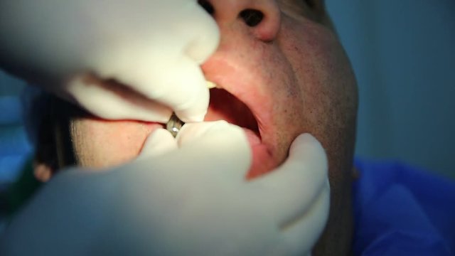 The mouth implants the tooth . Dental implant procedure . How do dental implants work graphic representation from dental implant placement to completing the tooth.