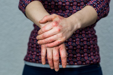 Young woman with dry and stressed red dyshidrotic eczema covered hands - 191733801