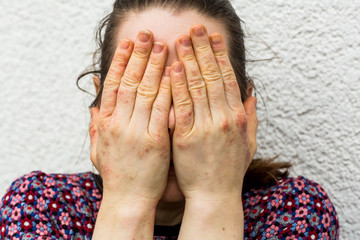 Young woman with dry and stressed red dyshidrotic eczema covered hands