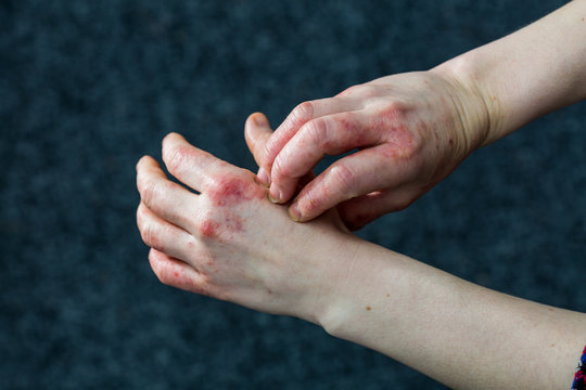 Young woman with dry and stressed red dyshidrotic eczema covered hands