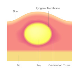pus and acne in skin vector