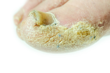Extreme bad foot skin bacterial fungal infection with damaged nail close up partially isolated on white background