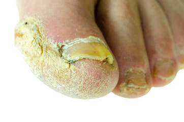 Extreme bad foot skin bacterial fungal infection with damaged nail close up partially isolated on...