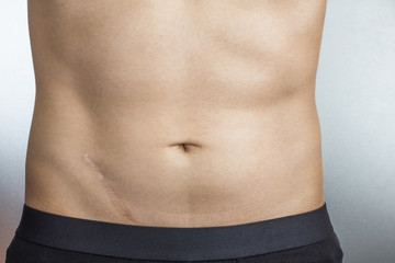 Fototapeta na wymiar Scars removal concept. Young man with large scar after surgery on abdomen, removal of appendicitis.