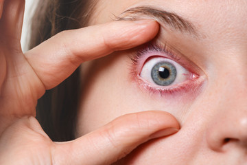 Woman`s red eye. Ill woman has conjunctivitis after fever attack. Problems with blood vesseles....