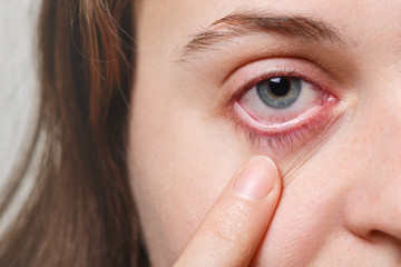 Medicine, health care and eyesight concept. Unrecognizable female shows her inflated red eye with blood capillary, has conjuctivitis. Woman with injured eye - obrazy, fototapety, plakaty