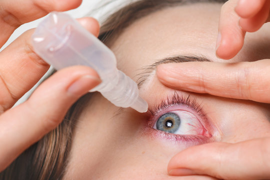 Close Up Shot Of Female Pours Drops In Red Eye, Has Conjuctivitis Or Glaucoma, Bad Eyesight And Pain. Eyes Pain Treatment Concept. Woman Cures Red Blood Eye