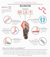 Foot deformation as medical desease infographic. Causes of bunion