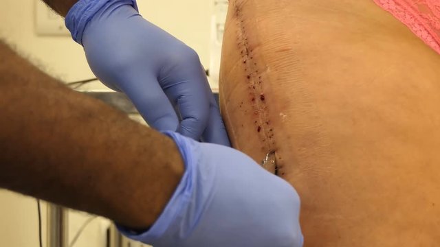 Black male nurse hands close up when removing metal staples or clips from healed wound after hip replacement surgery or operation