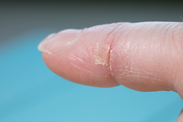 cold cut on index finger