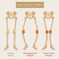 Vector Rickets Scheme
