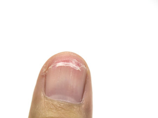 .Shred nails show bad nail health. Lack of vitamins and calcium And should use nail clippers cut should not be pulled out.