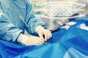 Minimally invasive cardiology transcatheter angioplasty stent treatment for coronary artery using a...
