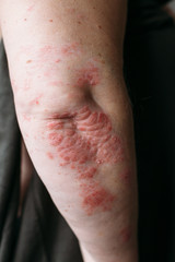 Psoriasis on elbow. Closeup photo of dry flaky skin with red spots