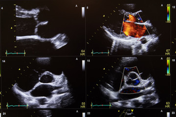 Heart ultrasound image on a computer screen.