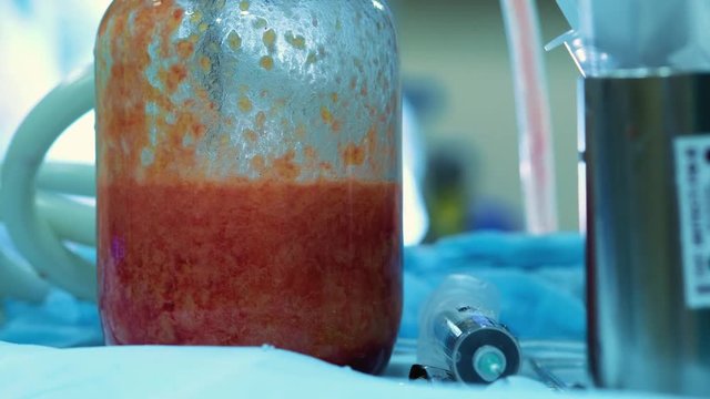 fat removal and Liposuction surgery Fat seeker. human fat in the glass after liposuction. Drain excess calories during surgery.