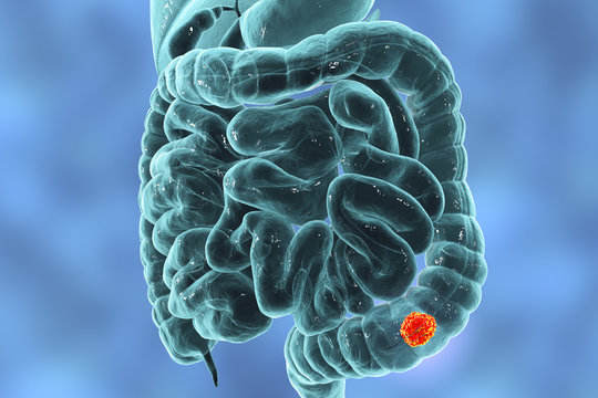 Colorectal cancer awareness medical concept, 3D illustration showing cancerous tumor inside large intestine