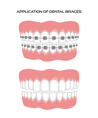 Teeth with braces on white background.