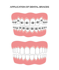 Teeth with braces on white background.