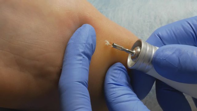 removal of corns with liquid nitrogen