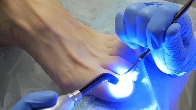 treatment of psoriasis of nails by ultraviolet